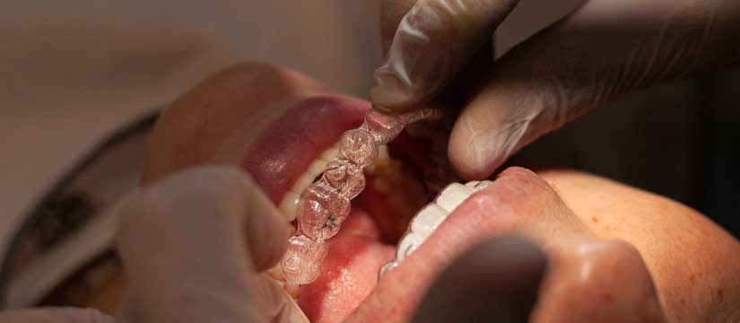 alinear-les-dents-sense-que-es-noti