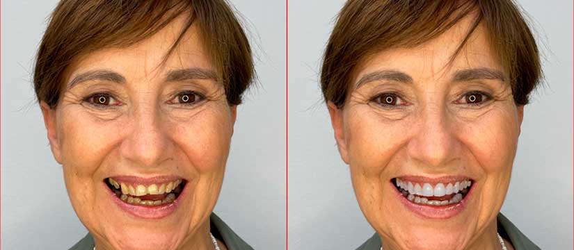 dsd-diseño-de-sonrisa-clinica-dental-soto