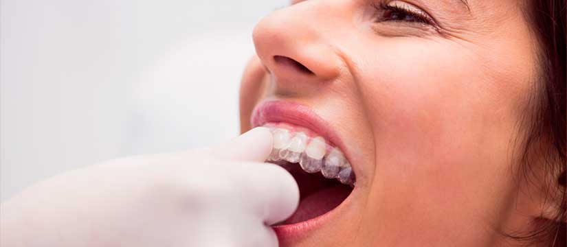 ortodoncia-invisible-invisalign-clinica-dental-soto