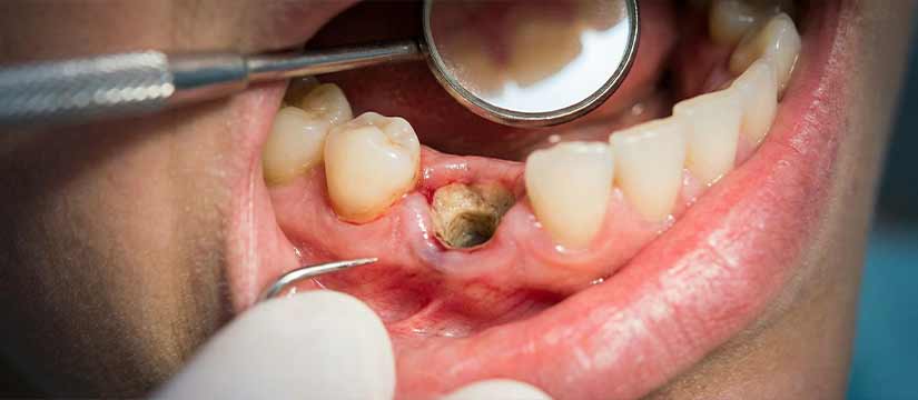 alveolitis-seca-causes-simptomes-i-tractaments-essencials