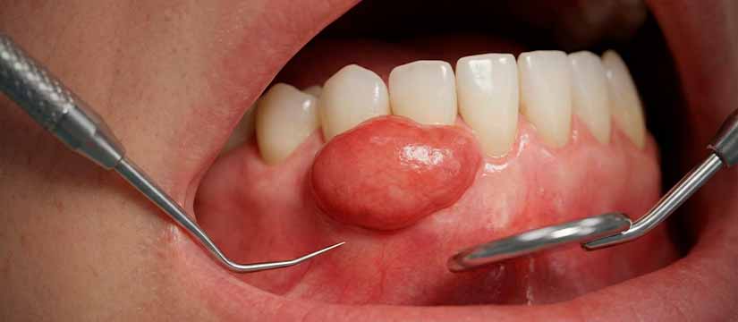 epulide-dental-causes-tipus-i-tractament-efectiu