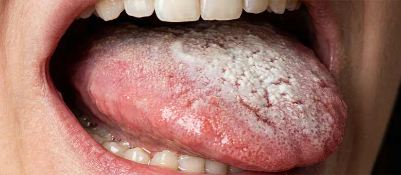 fongs-en-la-boca-causes-simptomes-i-tractament-de-la-candidiasi-oral